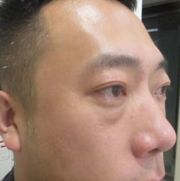 去眼袋手术