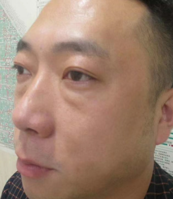 去眼袋手术