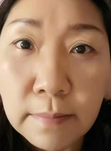 去眼袋手术