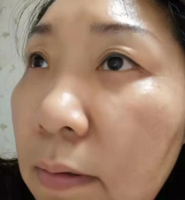 去眼袋手术