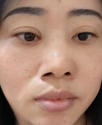 去眼袋手术