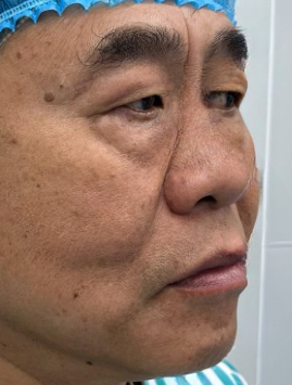 去眼袋手术
