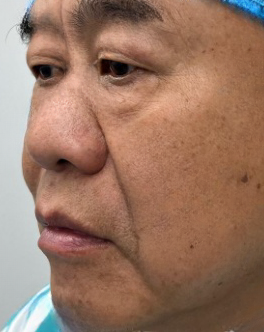 去眼袋手术
