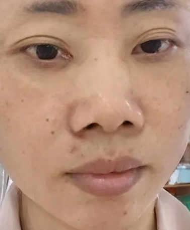 去眼袋手术
