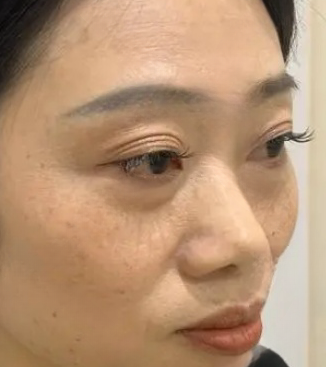 去眼袋手术