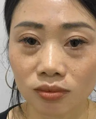 去眼袋手术