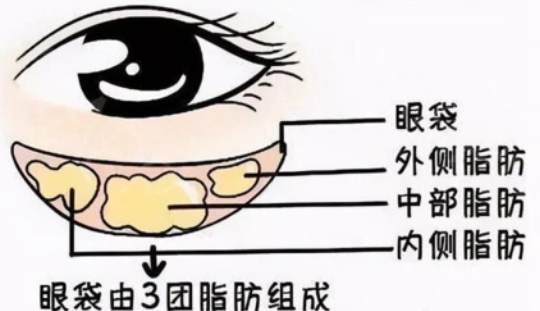 去眼袋手术