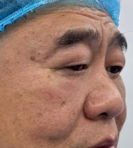 去眼袋手术