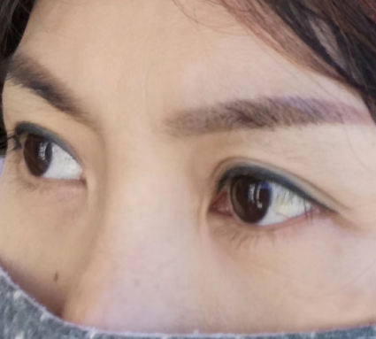 去眼袋手术