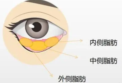 去眼袋手术