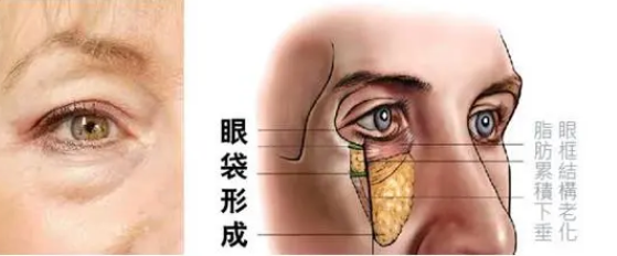 去眼袋手术