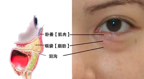 去眼袋手术