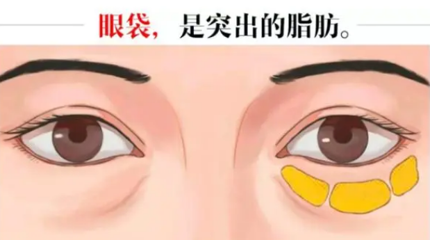 去眼袋手术