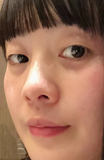 去眼袋手术