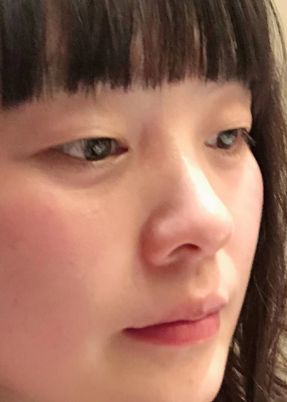 去眼袋手术