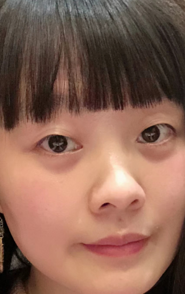 去眼袋手术