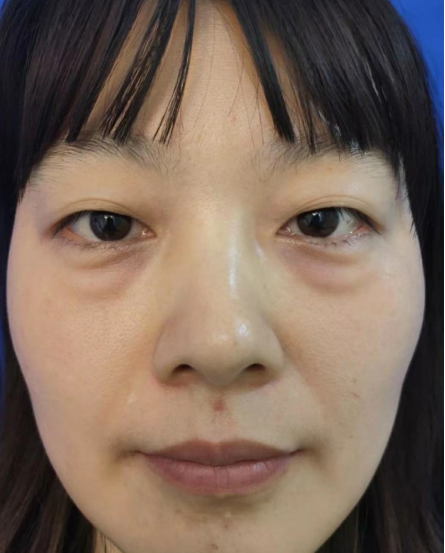 去眼袋手术