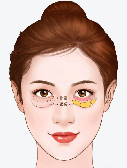 眼袋
