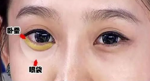 眼袋