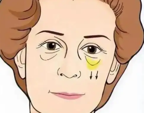 眼袋