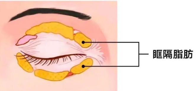 眼袋