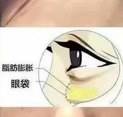 去眼袋
