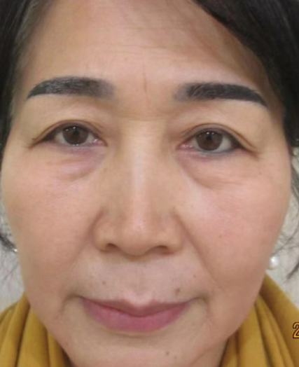 去眼袋