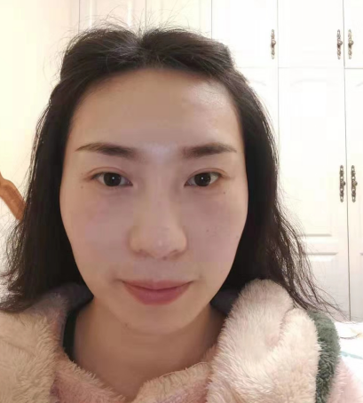 去眼袋