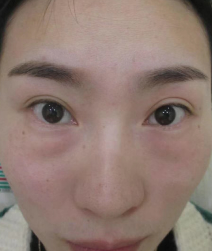 去眼袋