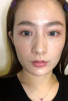 去眼袋