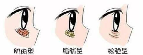 去眼袋手术