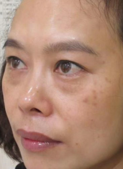 去眼袋手术