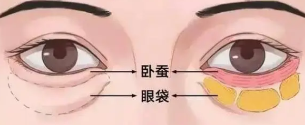 去眼袋手术