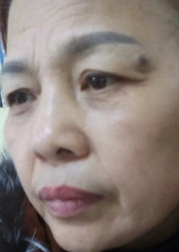 去眼袋手术