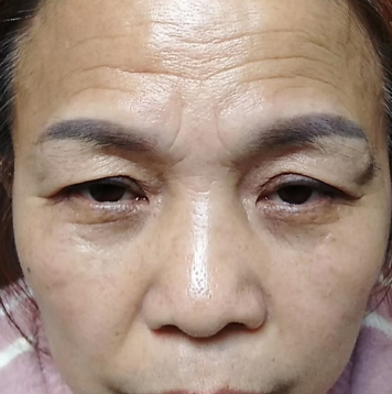 去眼袋手术