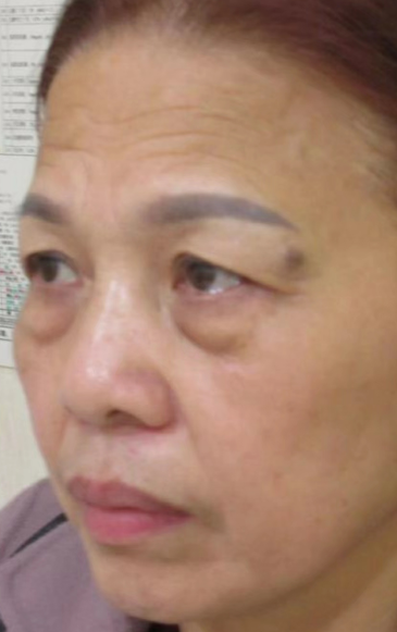 去眼袋手术