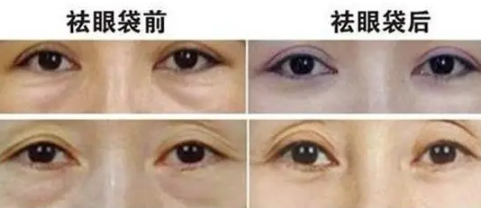 去眼袋手术