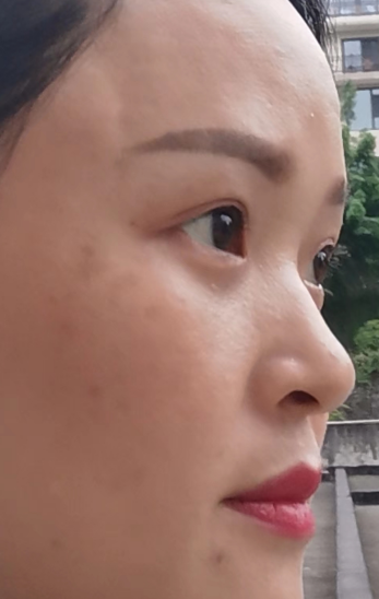 去眼袋手术