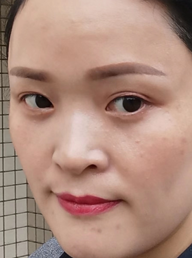 去眼袋手术