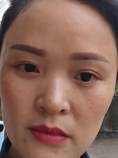 去眼袋手术