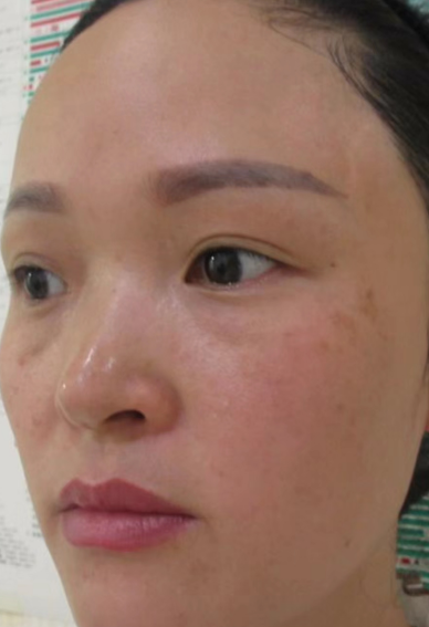 去眼袋手术
