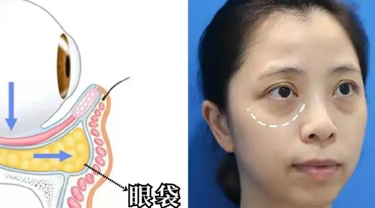 去眼袋手术