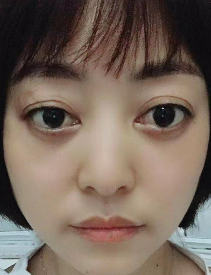 去眼袋手术