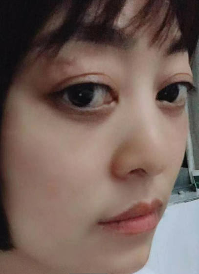 去眼袋手术
