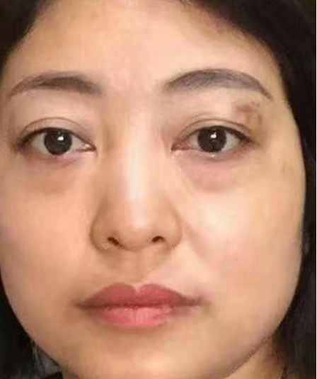 去眼袋手术