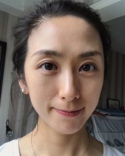 去眼袋手术