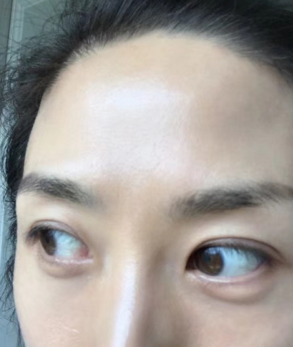 去眼袋手术