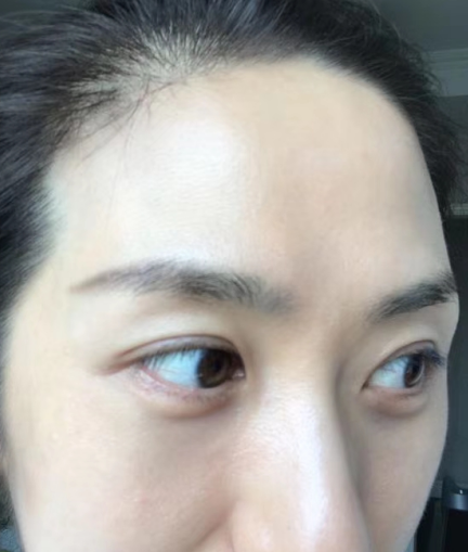 去眼袋手术