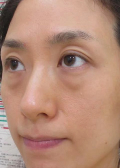 去眼袋手术