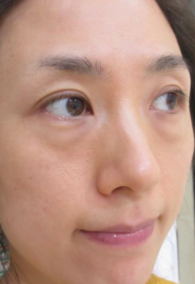 去眼袋手术